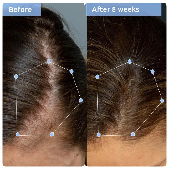 Hair Growth & Anti Hairfall Duo - Image 5